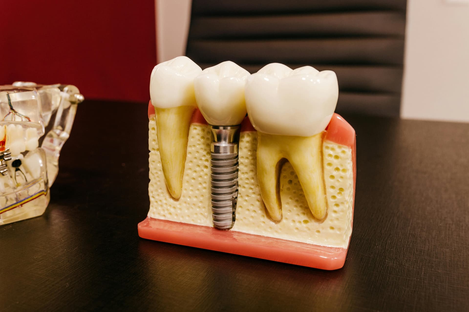 Implantes Dentários